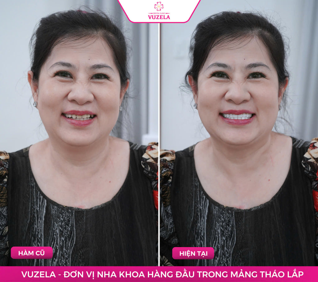 Hàm tháo lắp composite