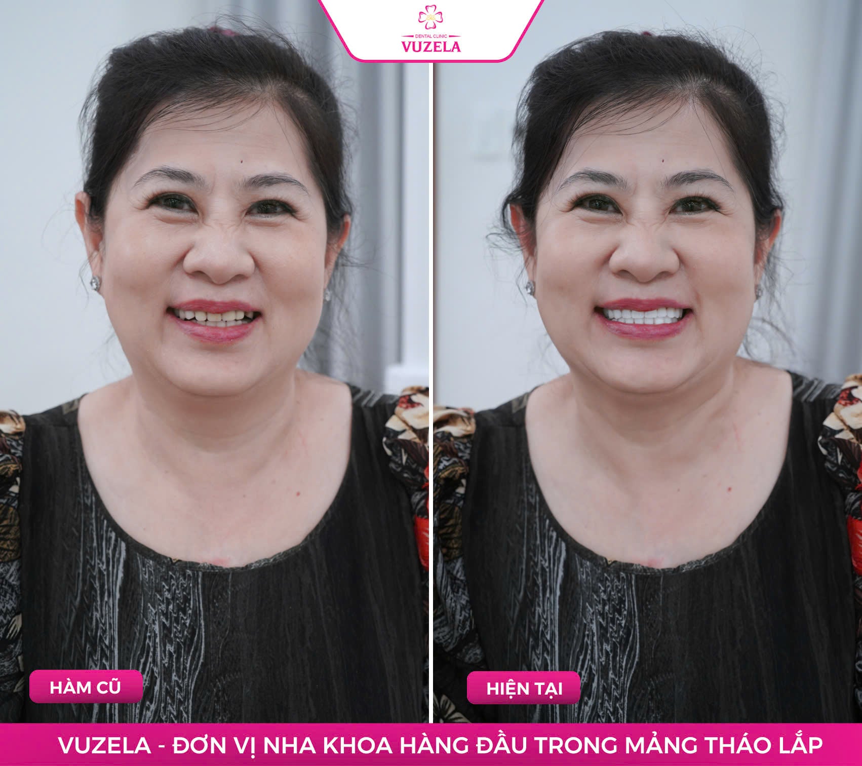 Hàm tháo lắp composite