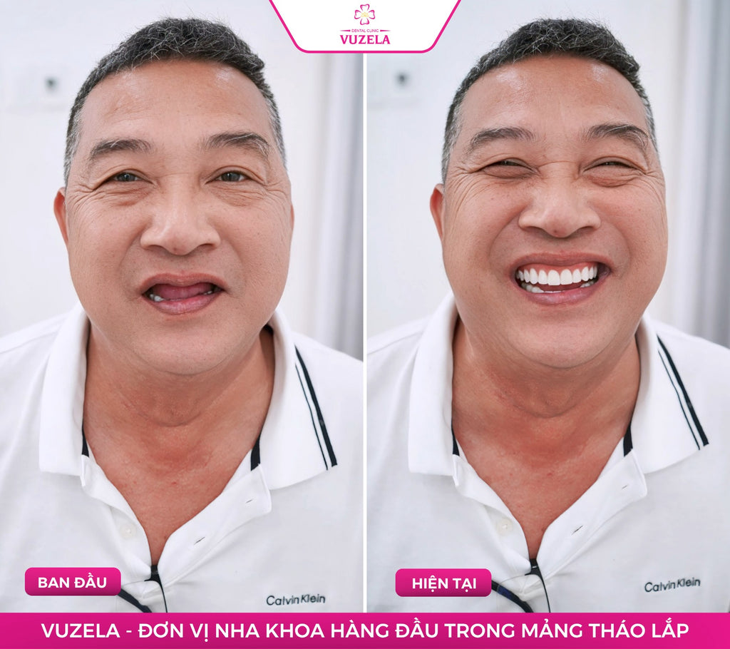 Hàm tháo lắp composite