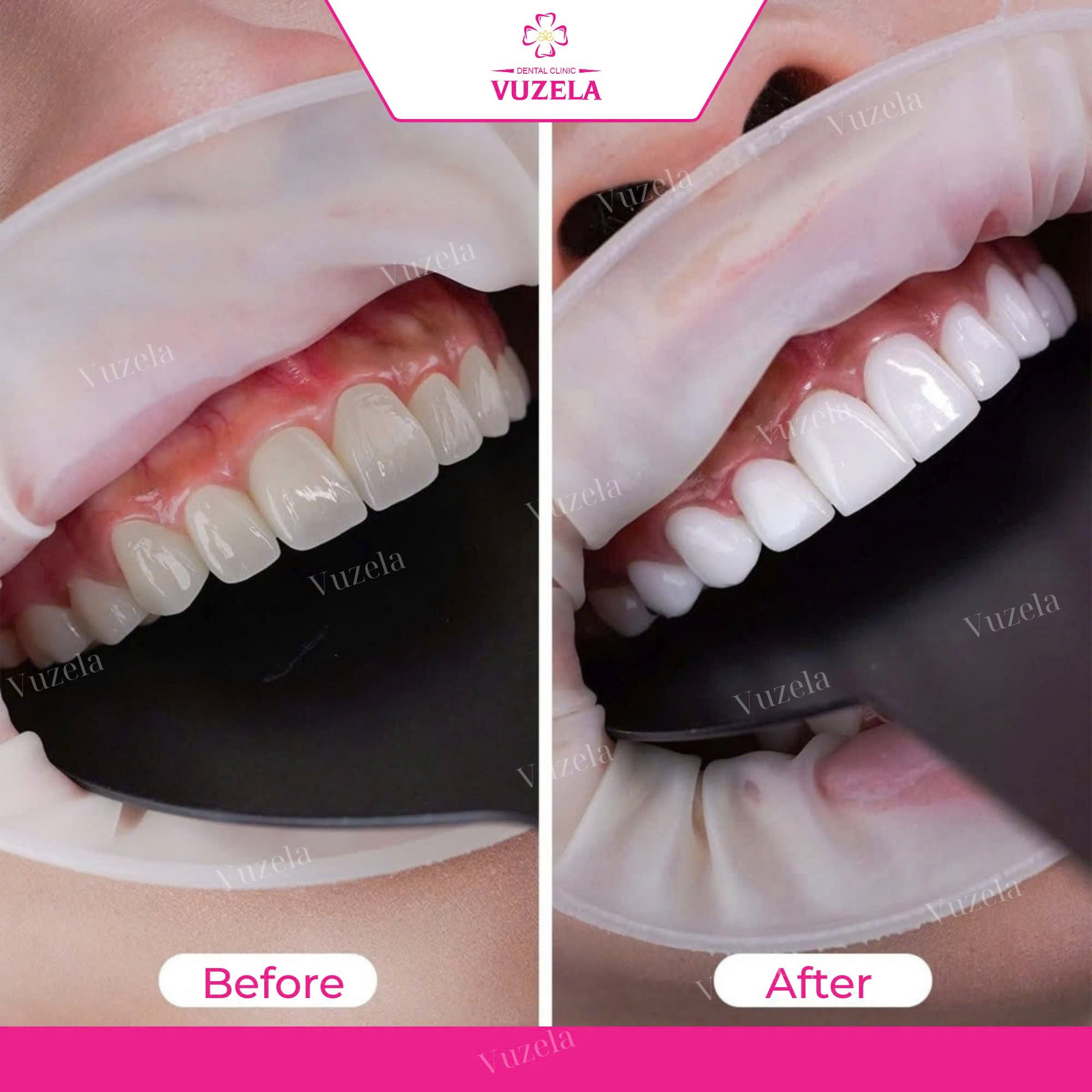 Răng sứ Lava Plus