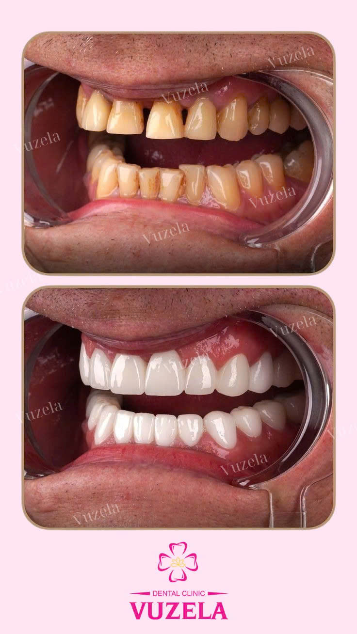 Răng sứ Cercon HT