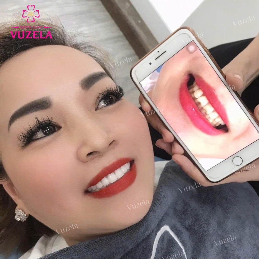 Bọc răng sứ thẩm mỹ