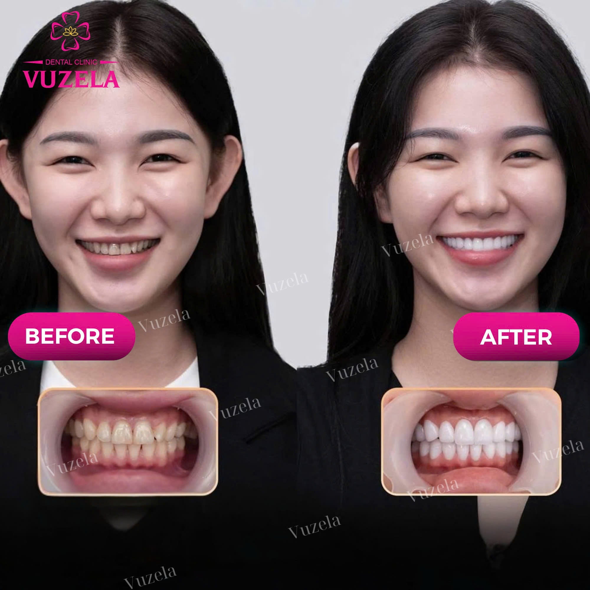 Bọc răng sứ thẩm mỹ