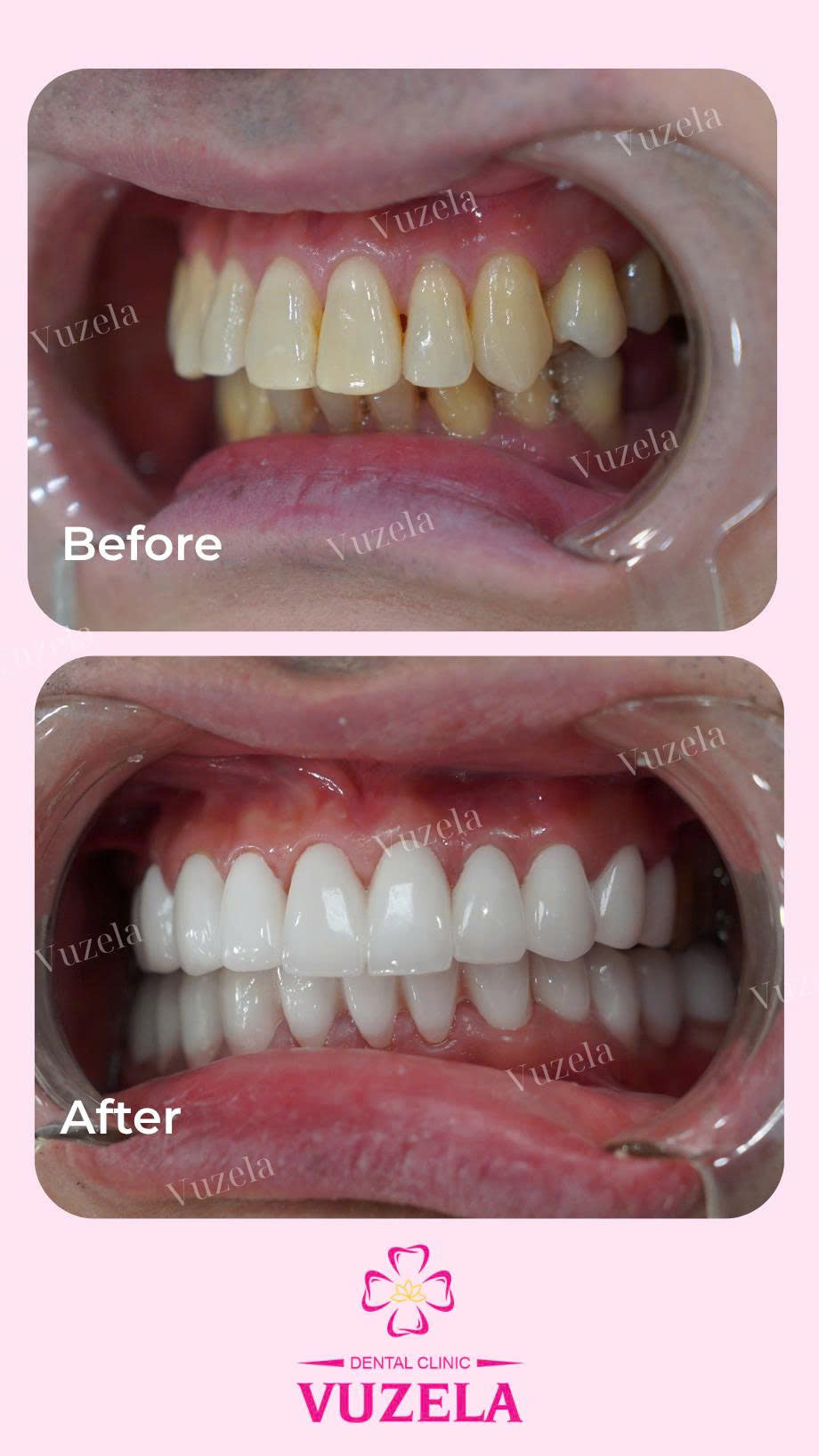 Bọc răng sứ thẩm mỹ