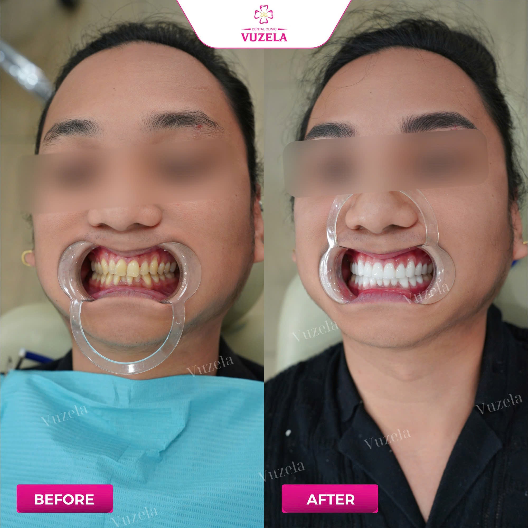 Bọc răng sứ thẩm mỹ