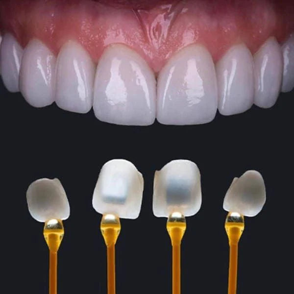 Mặt dán sứ Veneer