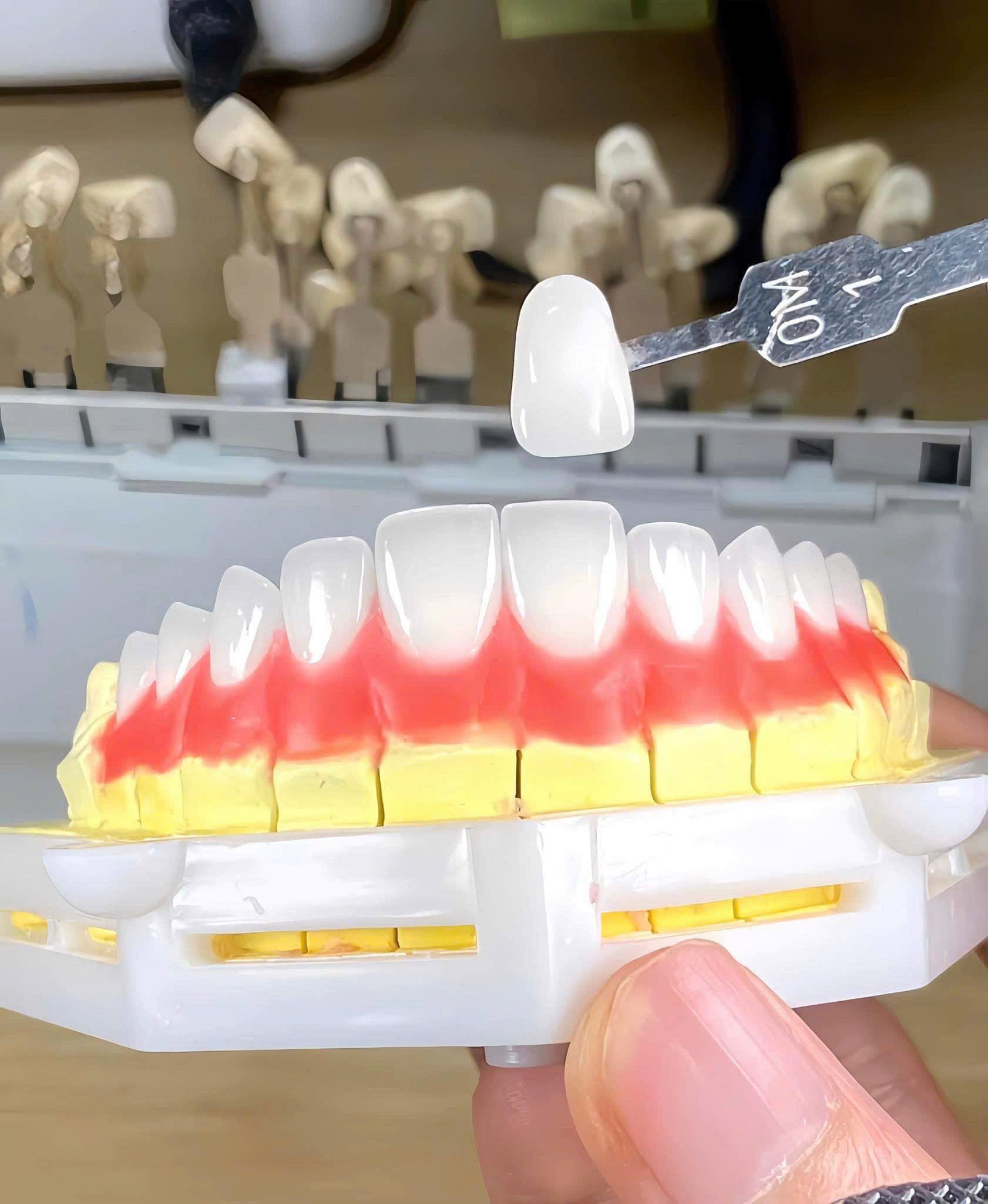 Mặt dán sứ Veneer